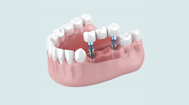 インプラント、本物の歯と同じようにしっかり噛みたい、インプラントに興味がある、ブリッジで歯を削りたくない